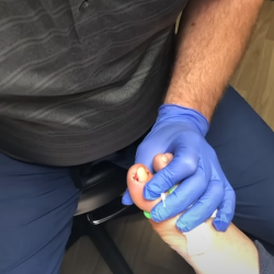 Tırnak Batması Durumunda Ne Yapmak Gerekir?