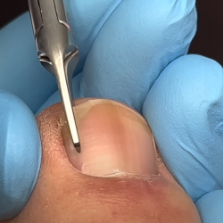 Tırnak Batması Bakımı Öncesi Temizlik