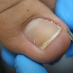 Tırnak Batmasının Sebepleri